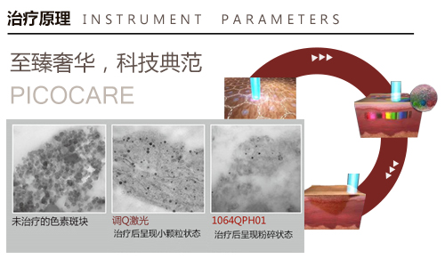 Ƥ�뼤��x��1064QPH01�_�����������¼o(j��)Ԫ